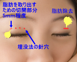 瞼脂肪除去のイメージ